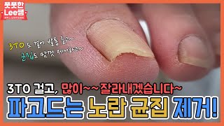 파고들었던 노란발톱 3TO 걸고 많이 잘라낼게요~ ingrown toenail / ingrowing nail - Fresh Foot 성수점 / 남양주호평점