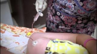 Accessing and De-accessing an Implanted Port