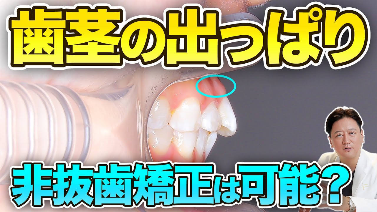 歯茎が出ていても矯正は可能？非抜歯矯正時のデメリットや口元を下げて口ゴボを改善する方法を症例をもとに解説【審美歯科 歯列矯正 歯並び Eライン】