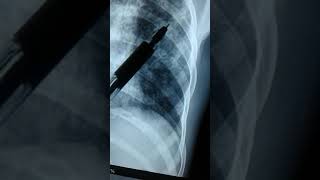 Miliary TB - A case prepared by Prof. Saleh Al-Awdhaly