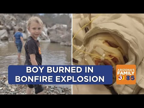 6-year-old Prescott boy burned in bonfire explosion