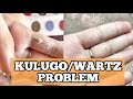 MURANG PANTANGGAL NG KULUGO/WARTS IN 3 DAYS | VERY EFFECTIVE