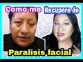 BELL'S  PALSY SINTOMAS Y COMO RECUPERARTE RAPIDO | MI EXPERIENCIA