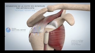 RÉPARATION DE LA COIFFE DES ROTATEURS PAR ARTHROSCOPIE - TECHNIQUE DOUBLE RANG - DR MATTHIEU MEYER