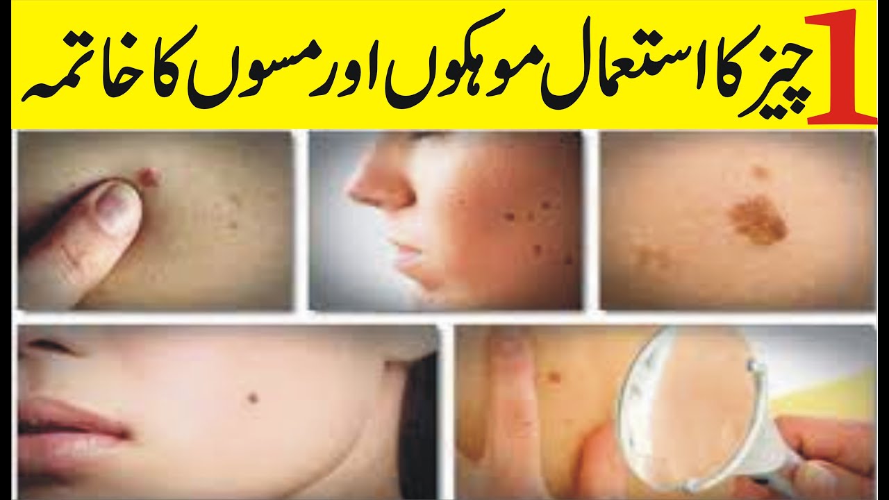 Moko Ka ilaj How to Rid Skin Tags and Warts Skin Ke Masse Ka ilaj in urdu and Hindi YouTube
