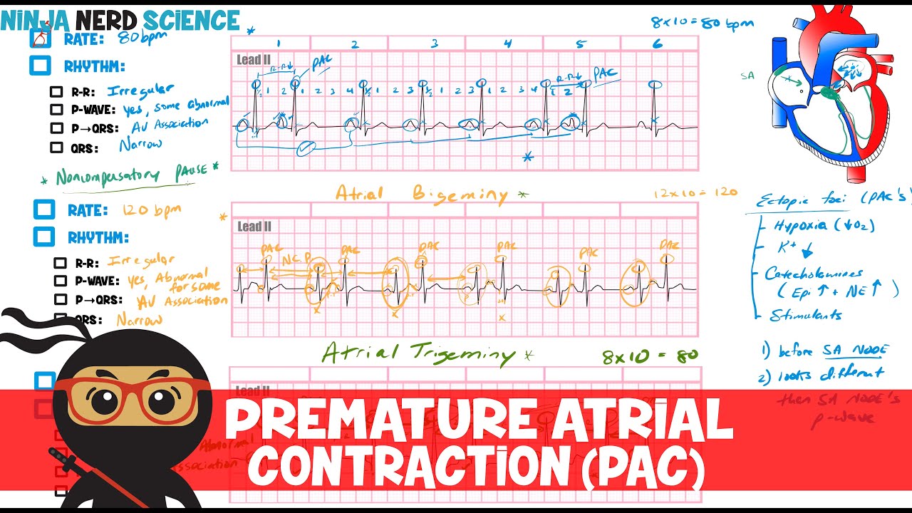 Premature Atrial Contractions