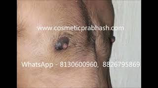 Reduction Surgery Keyhole Top Surgery Before After , India, Delhi