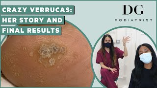 Verruca on feet treatment and final results | Client Interview | The Foot Scraper: DG Podiatrist