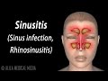 Sinusitis, Animation.