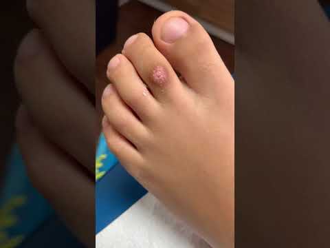 CASE UPDATE: MINI MONSTER TOE WART