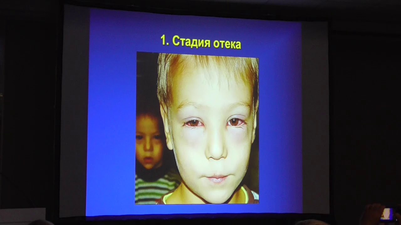 Аденовирусные кератоконъюнктивиты