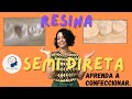 RESTAURAÇÃO DE RESINA SEMI DIRETA