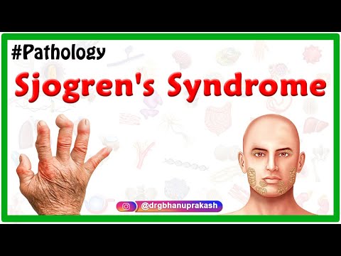 Sjogren&rsquo;s syndrome Usmle : Etiology , Clinical features , Diagnosis , Treatment