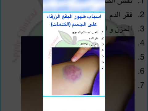 الكدمات الزرقاء في الجسم