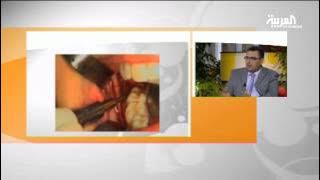 ضرس العقل..طرق حديثة لإزالته بدون ألم