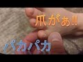 【苦痛】はがれる直前…。パカパカに。その後のアンサー動画