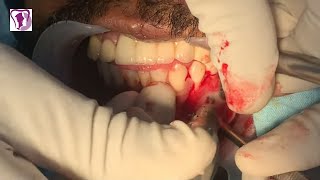 Two Wisdom Tooth Extraction and Apicectomy done Simultaneously - Oral Surgery in India