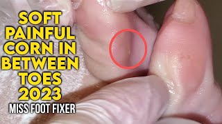 Soft " Painful " Corn in Between Toes 2023 [ Double Corn ] By Foot Specialist Miss Foot Fixer screenshot 4