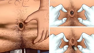 شاهد افضل طريقة لتنظيف سرة البطن من الأوساخ والريحة الكريهة _ ASMR|Remove Huge Navel Stone Animation