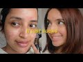 Vlog 130 i hate acne