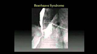 MANAGEMENT OF ESOPHAGEAL PERFORATIONS MANAGEMENT OF ESOPHAGEAL PERFORATIONS