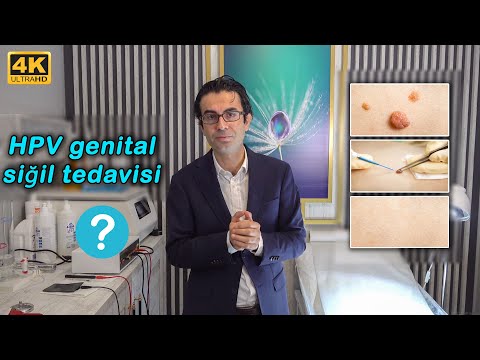 Erkeklerde #HPV  -  #Genital #Siğil Nedir? Tedavisi Nasıl Yapılır ? Doç. Dr. Muhsin Balaban