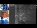 Transradial Uterine Artery Embolization for Symptomatic Uterine Fibroids (UFE)