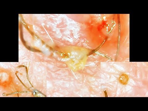 ingrown-pili-multigemini-blackhead-combo!-very-unique-and-satisfying.-^_^