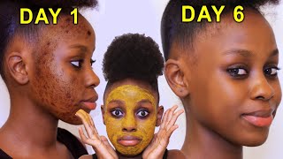 Kundoa WEUSI na MAKOVU SUGU usoni kwa siku chache tu | How to get rid of acne scars in days