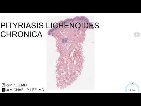Pityriasis Lichenoides Chronica. Dermpath Made Easy.