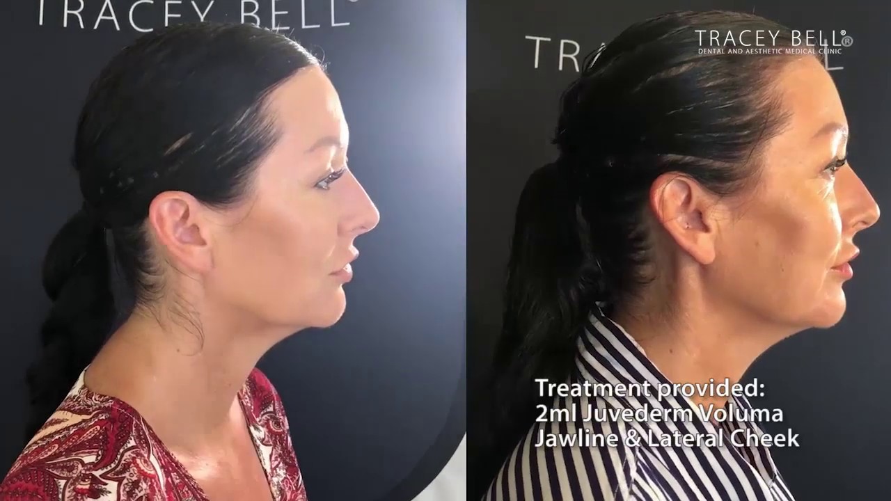 Jaw Line & Lateral Cheek treated with 2ml of Juverderm Voluma @ Tracey Bell Clinic