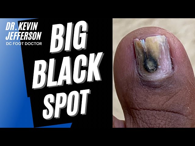 What Does It Mean When Your Toenail Turns Black? - The List | Toe nails,  Toenail turning black, Toe nail discoloration