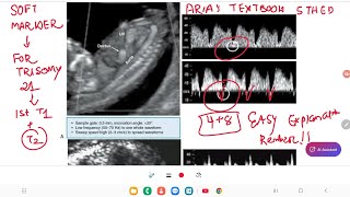 Soft marker for chromosomal Abnormality # Ultrasound marker/easy mnemonic/Arias high-risk pregnancy screenshot 5