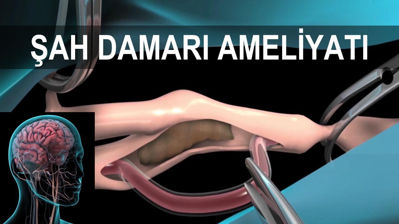Narrowing of the Carotid Artery 6 Narrowing of the Carotid Artery