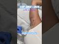 Reduce Sweat Odor Forever рџ Miradry Sweat Odorremoval Bodyodor Reduce Sweat Odor Forever рџ Miradry Sweat Odorremoval Bodyodor