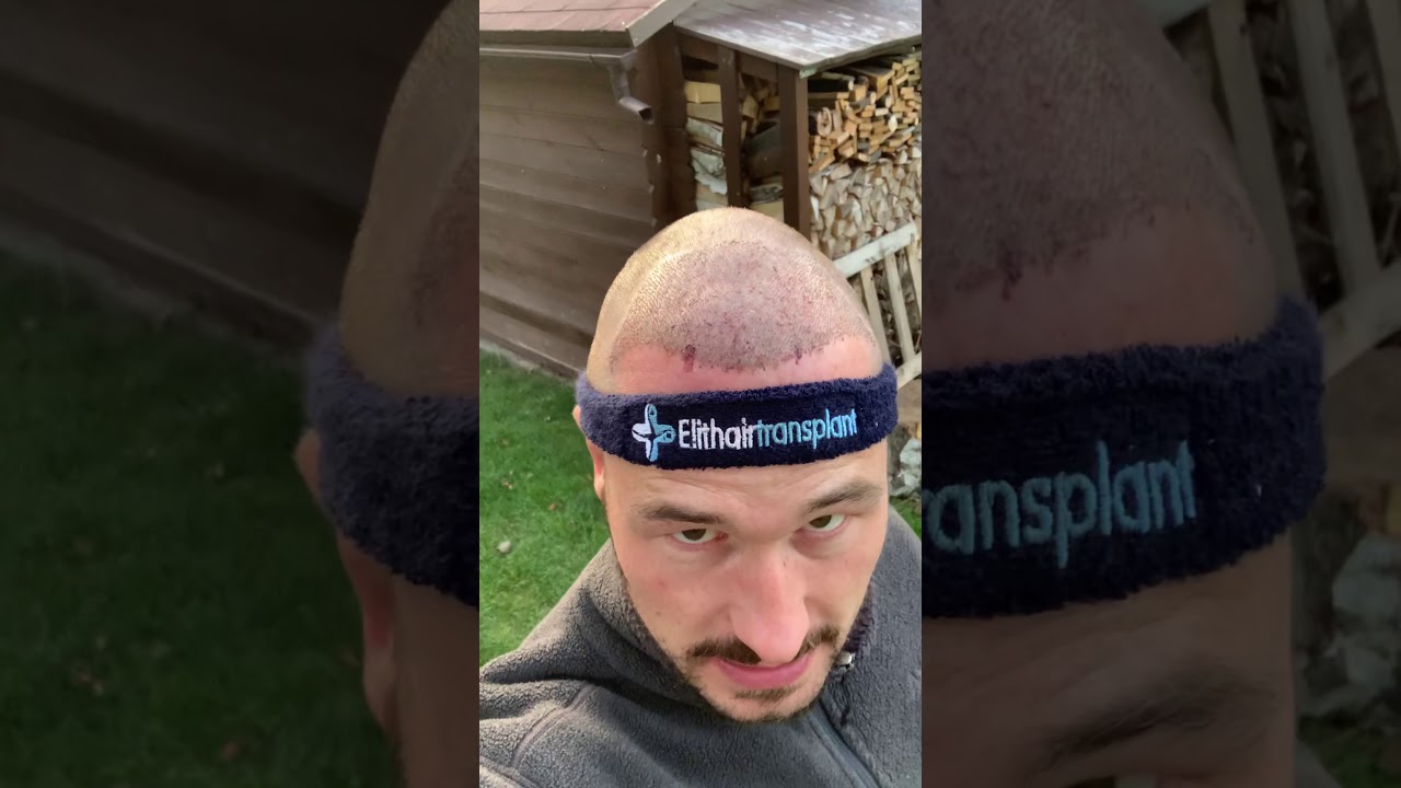 Elithehairtransplant 2 Tage nach Op YouTube