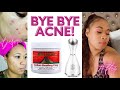 At Home: DIY Facial for Acne Oily Skin | Aztec Secret Healing Clay and Facial Steamer