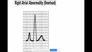 ECG 2 Prof Dr Walaa Elsalakawy mp4