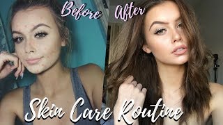 HOW I CLEARED MY SKIN FAST