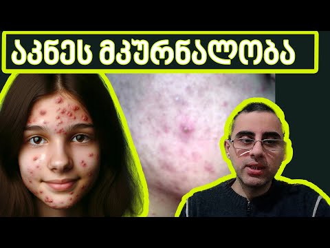 აკნე - გამონაყარი სახეზე,  ყველაფერი რაც აკნეზე უნდა იცოდე