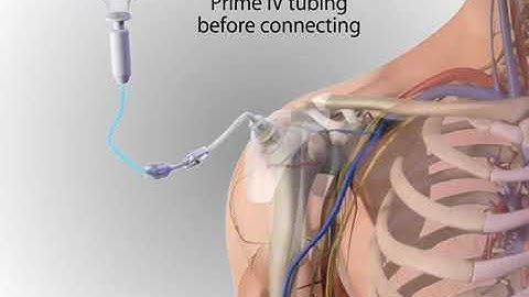 Arrow® EZ IO® System   Proximal Humerus Site IdentificationInsertion Adult, Animation