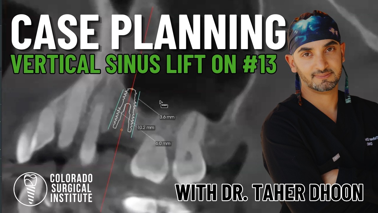 Vertical Sinus Lift on #13: The Sloped Sinus Floor That Catches