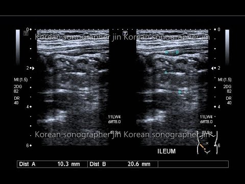 Sonography of small bowel,mesentery 위장관초음파(terminal ileitis sono,panniculitis,mesentneric lymphoma,)