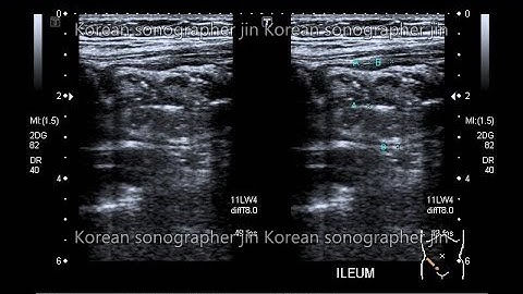 Sonography of small bowel,mesentery 위장관초음파(terminal ileitis sono,panniculitis,mesentneric lymphoma,)