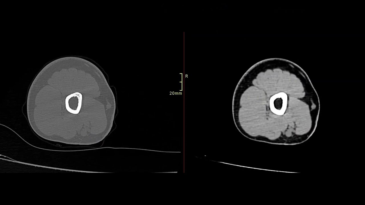 Укладка локтевого сустава для компьютерной томографии