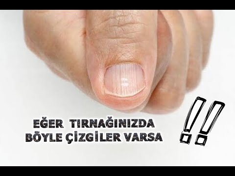 DİKKAT !!   TIRNAKLARDAKİ İZLER SAĞLIĞIMIZ  HAKKINDA BİLGİ VERİYOR..