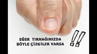 Di̇kkat Tirnaklardaki̇ İzler Sağliğimiz Hakkinda Bi̇lgi̇ Veri̇yor