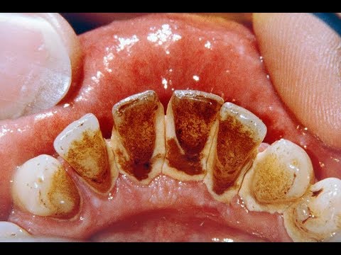 this-one-common-ingredient-will-get-rid-of-plaque-&-tartar-and-remove-bad-breath-as-well