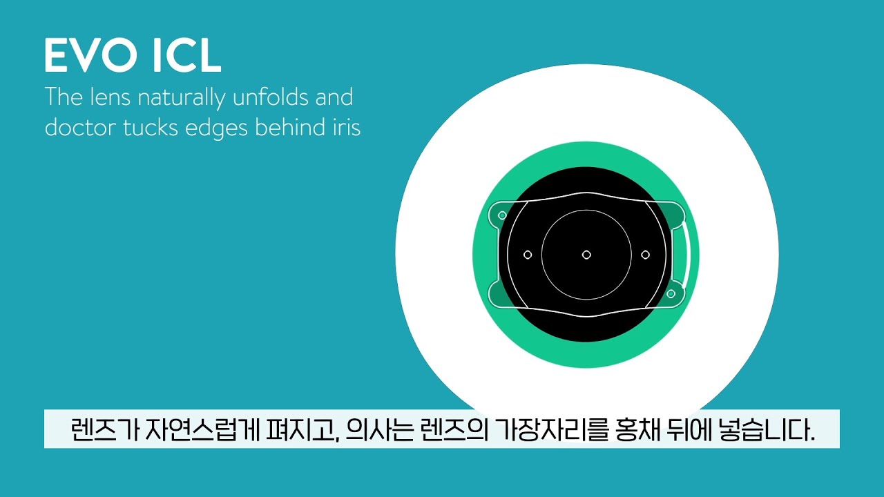 [Айриум Нүдний Эмнэлэг] #Хараа засах линз #Ибо ICL #Линз суулгах мэс заслын онцлог