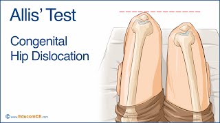 Allis Test